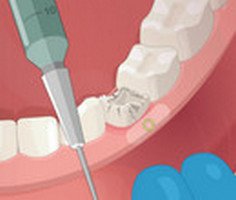 Dental Implant